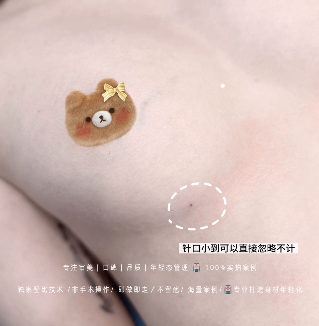 针口恢复案例
